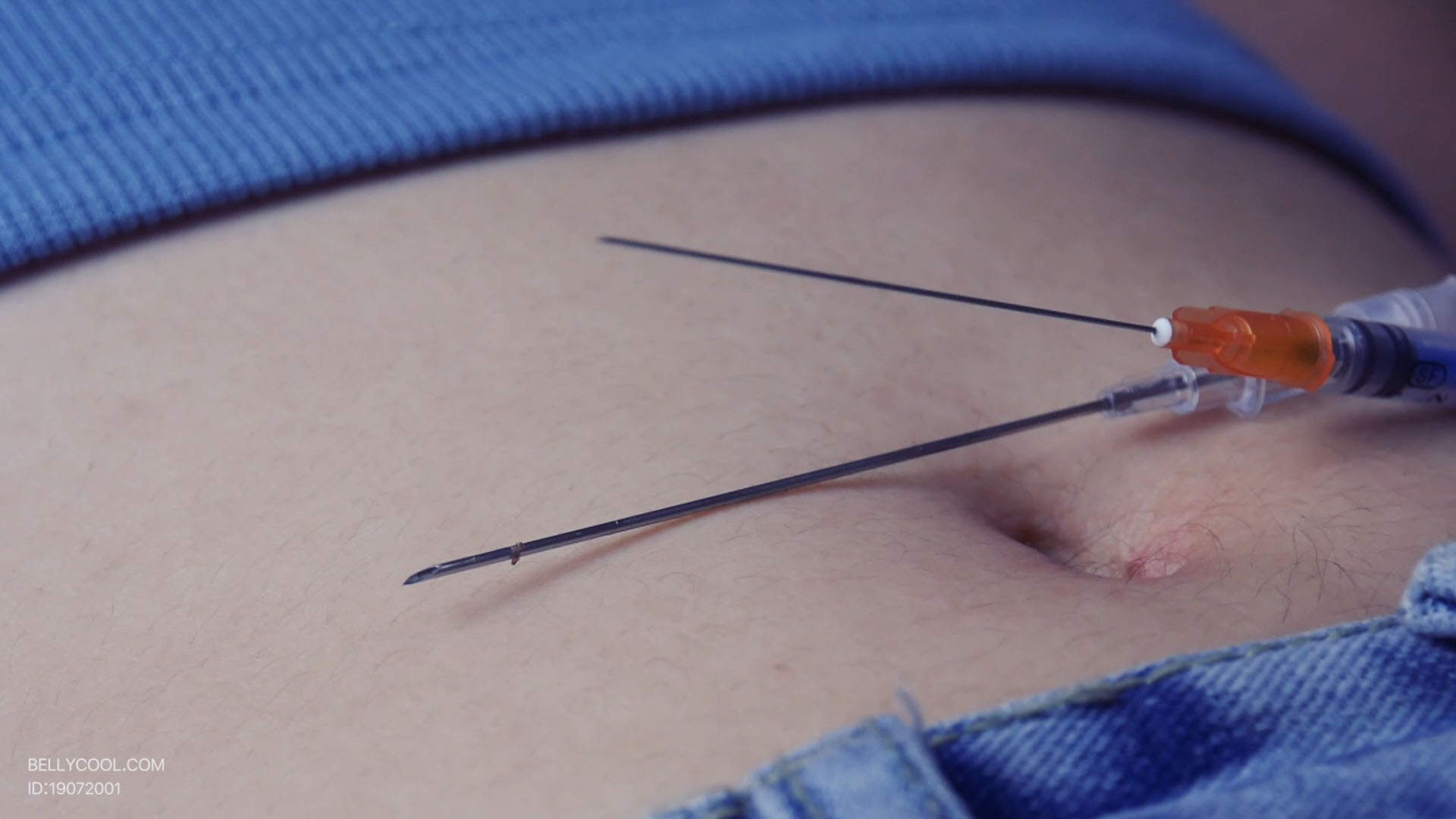 Sale navel needle is stock